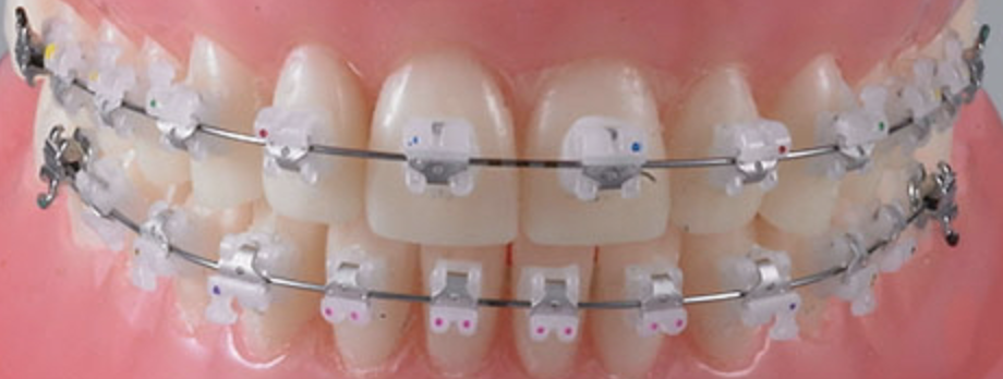 Clippy-C Braces (Self-Ligating Braces)