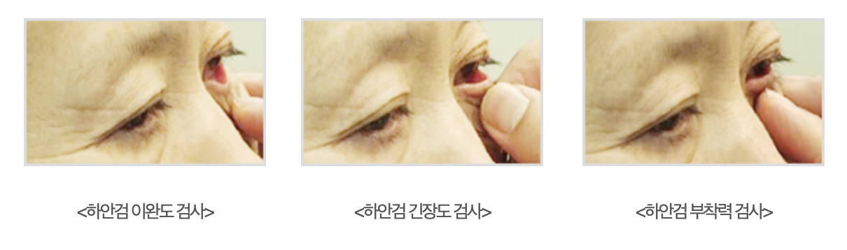 下眼瞼手術(下眼瞼形成術)