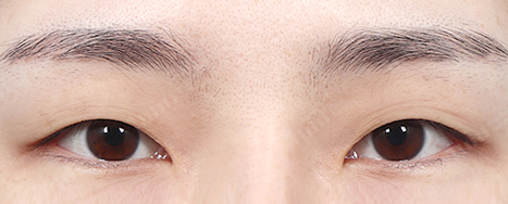 눈 밑 지방 재배치