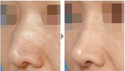 鼻の突出(ハンプ)修正術(鼻背ハンプ修正手術)