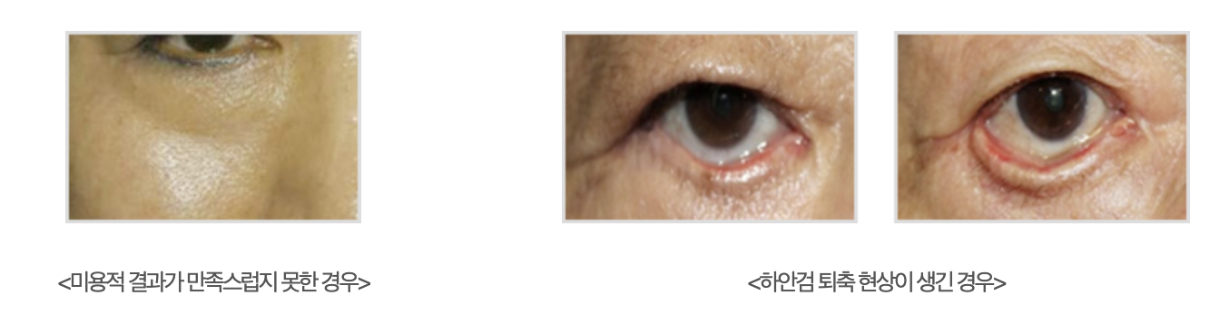 하안검 재수술 (이차 하안검성형술)