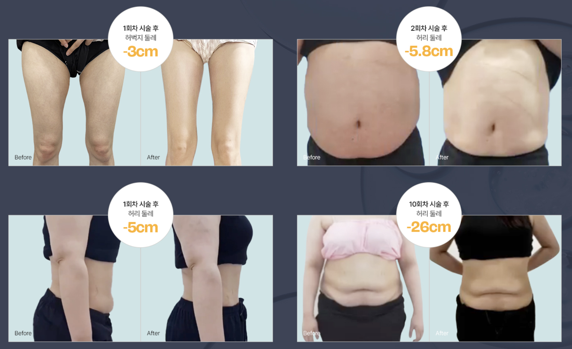 脂肪溶解プログラム（非外科的痩身）