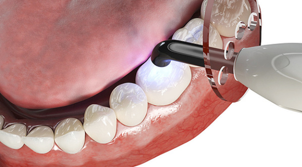 修复性治疗和补牙