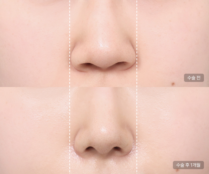 Alar Reduction Surgery