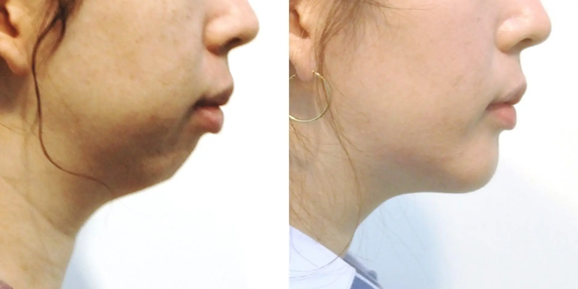 Chin Reduction Surgery