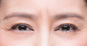 眉间纹治疗(去除眉心纹)