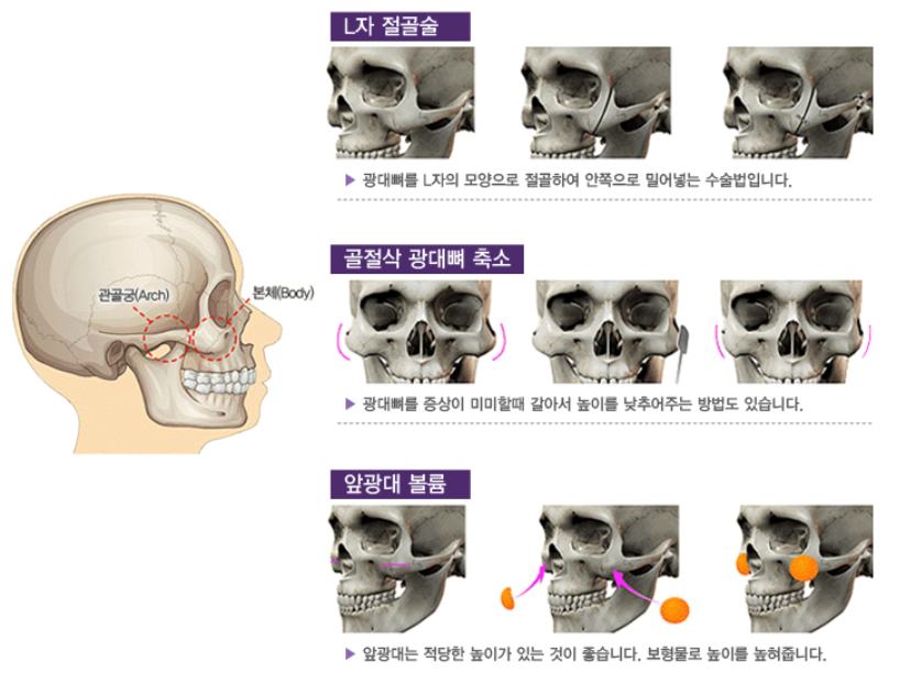 광대뼈 축소술 (관골 축소술)