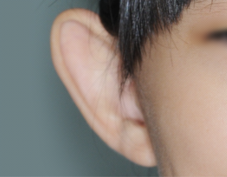 招风耳矫正术(突出耳朵耳廓成形术)