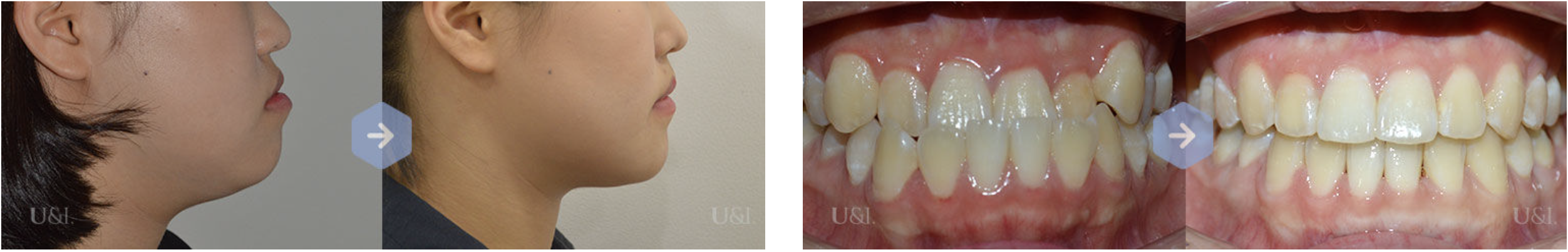 非外科的顎矯正