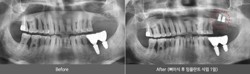 임플란트를 위한 뼈이식 및 상악동거상술