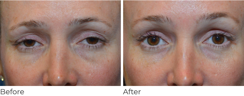 안검하수 재수술