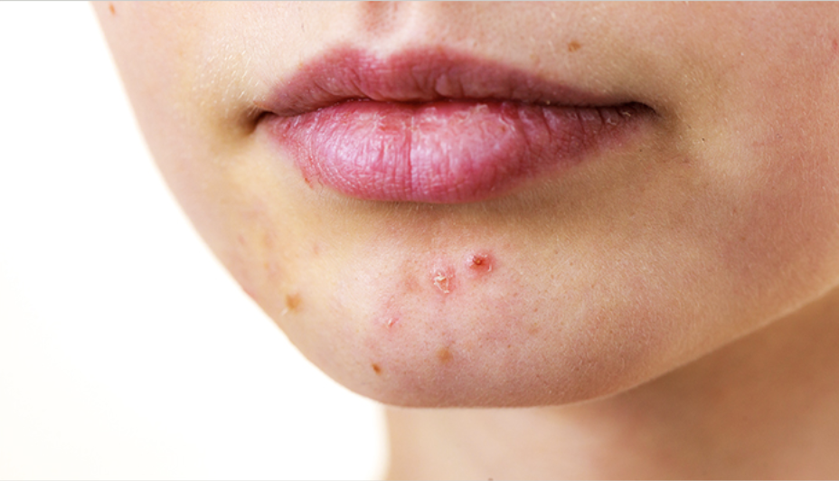 幹細胞ニキビ跡治療