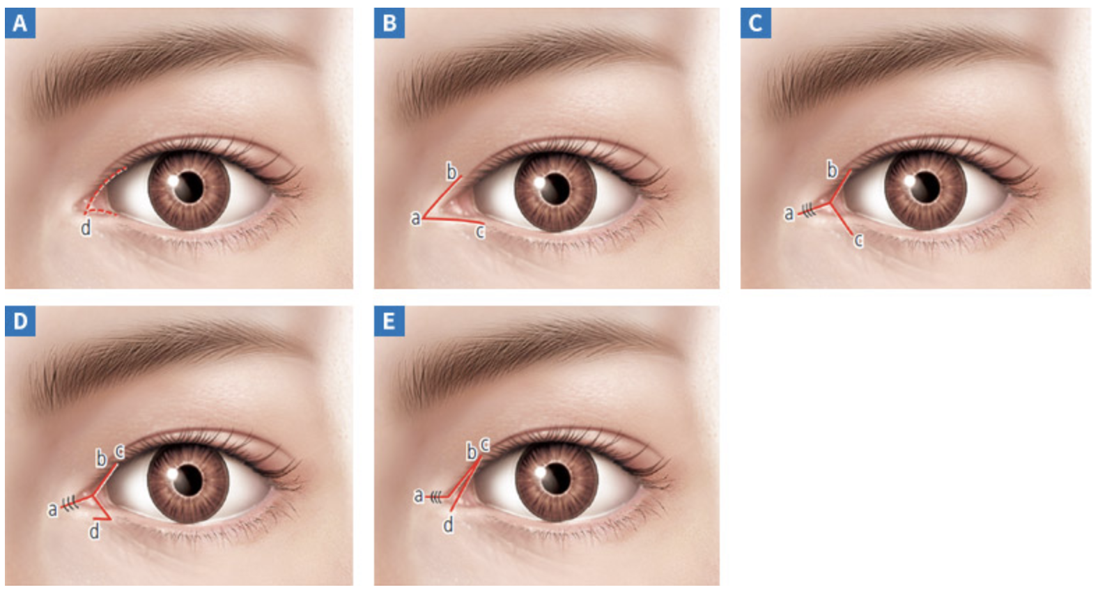 Revision Epicanthoplasty & Lateral Canthoplasty