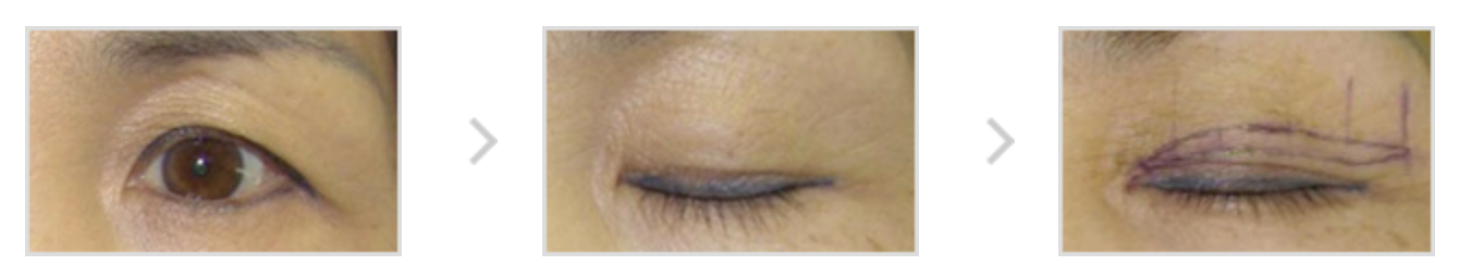 二重修正手術(二次眼瞼形成術)