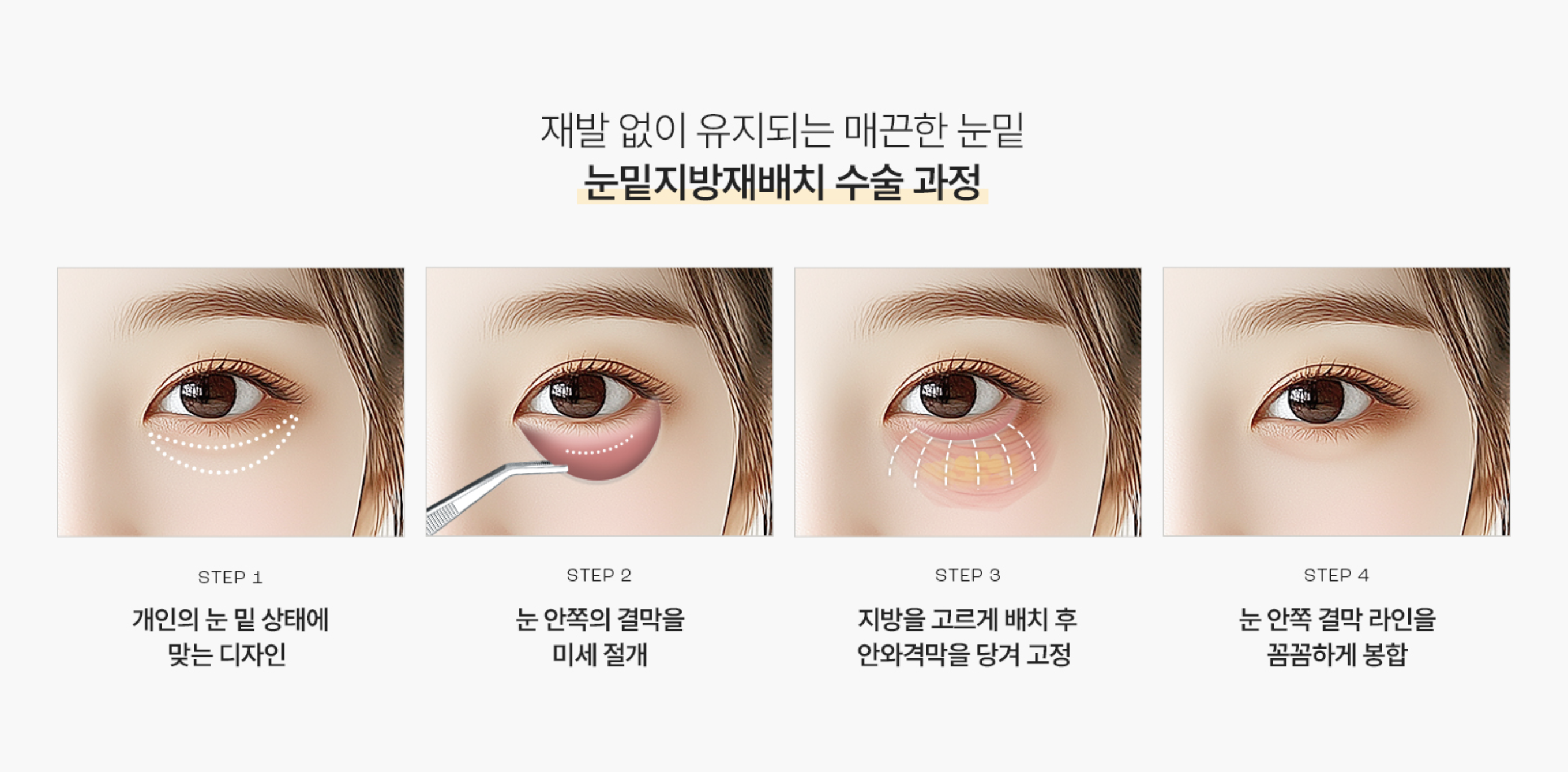 눈 밑 지방 재배치