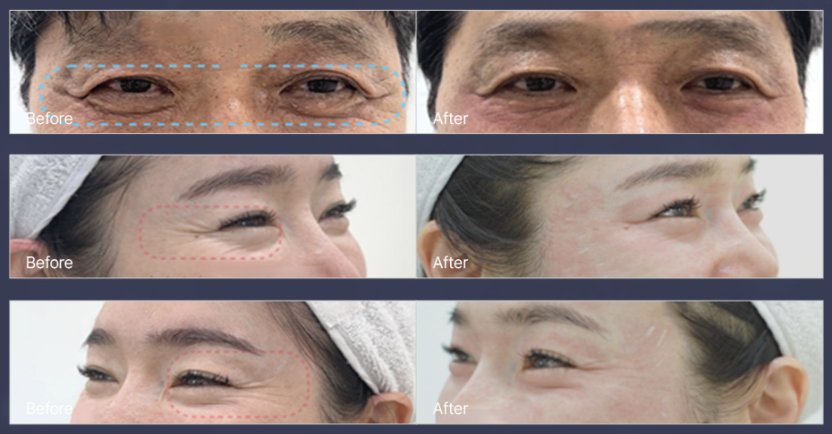 Wrinkle Removal Program