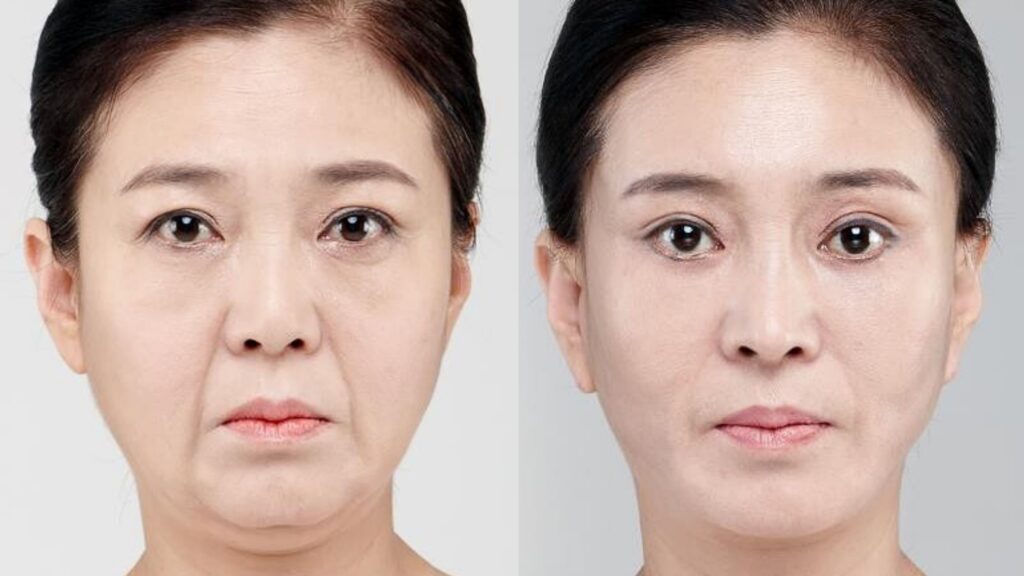 안면 리프트 수술 (페이스리프트)