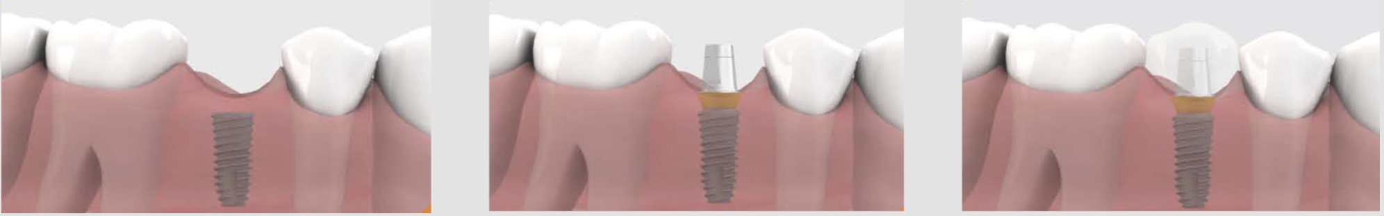 치과 임플란트 (표준형)