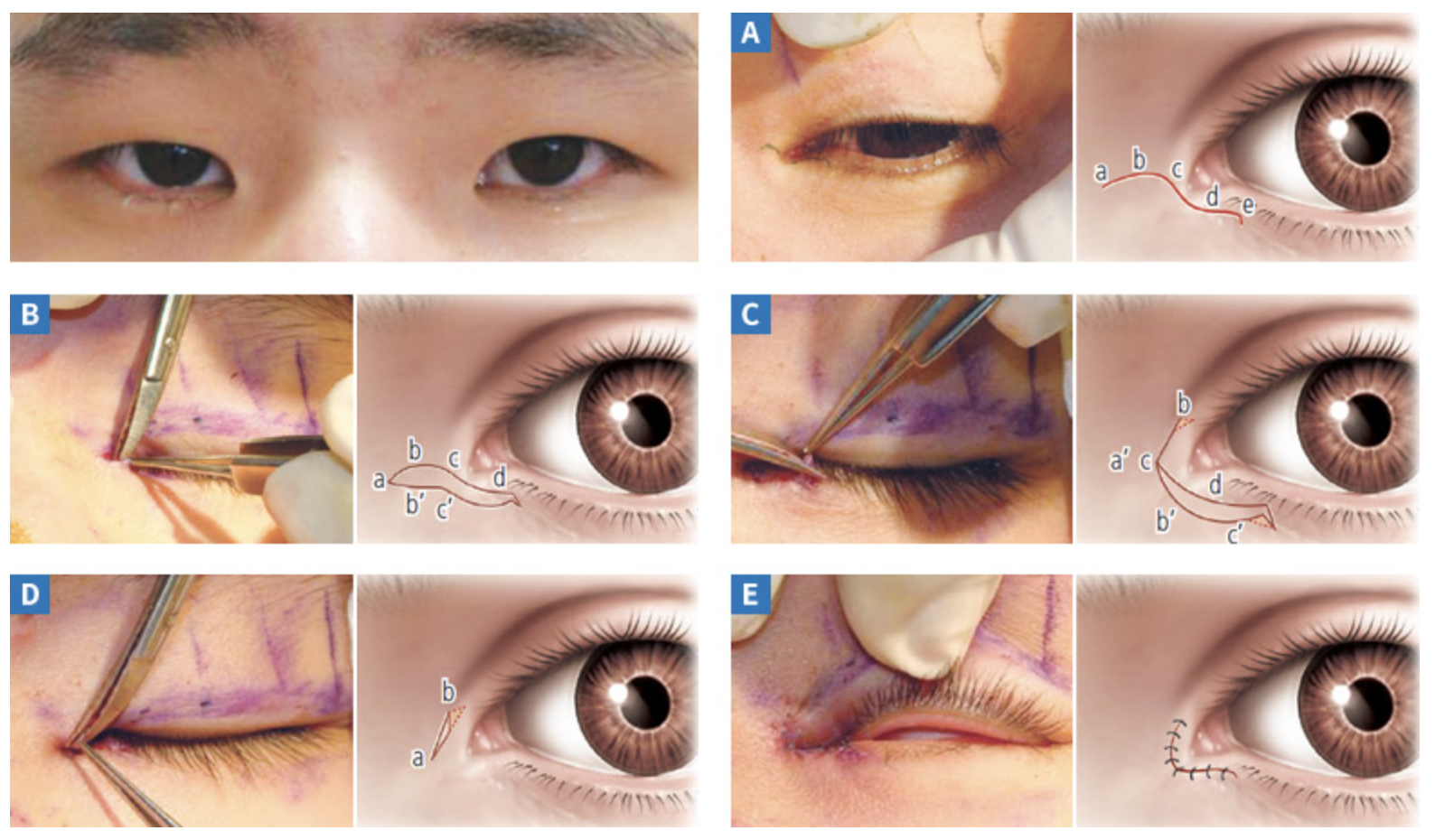 目頭切開術と目尻切開術(目元形成手術)