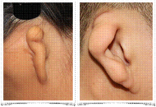 소이증 재건술 (선천성 귀 재건 수술)