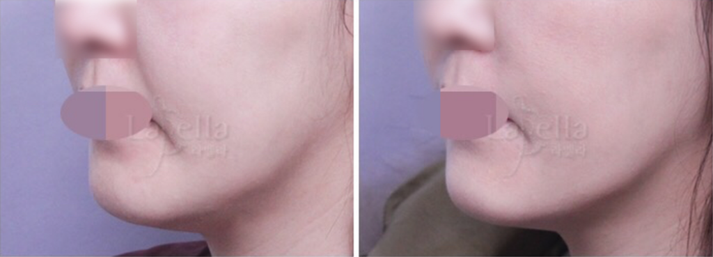 耳介軟骨移植による隆鼻術（耳介軟骨鼻形成術）