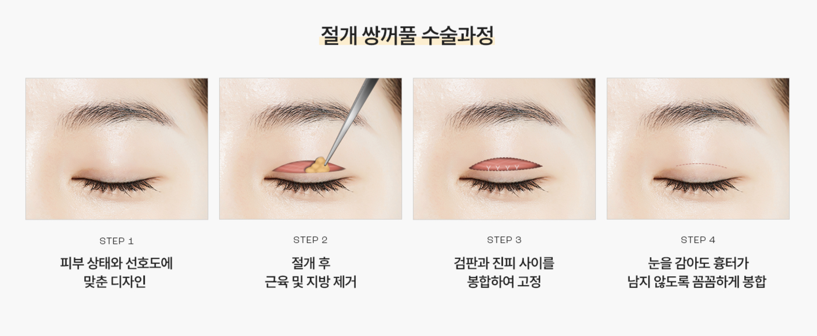 二重まぶた手術 – 切開法