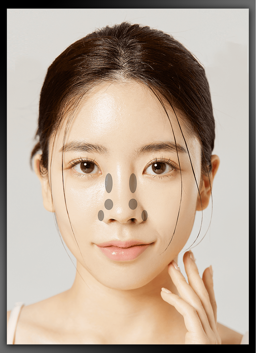 Nose Contouring Injection