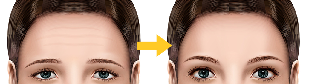 内視鏡下眉挙上術