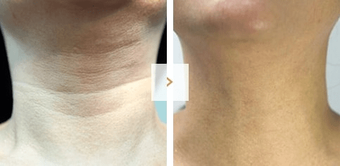 首のしわ取り手術