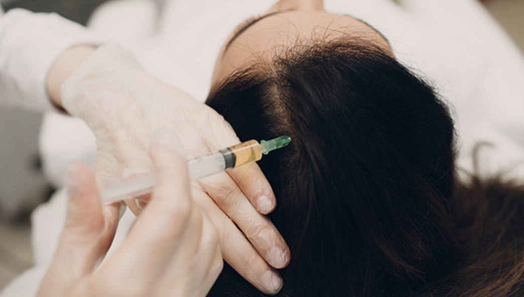 탈모 줄기세포 치료