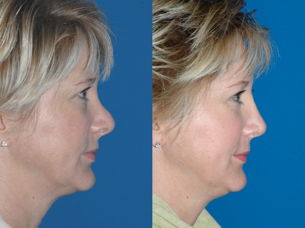 코 재수술 (이차 코 수술)