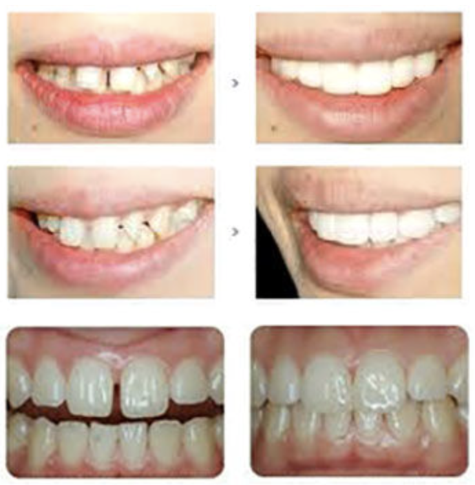 치아 라미네이트