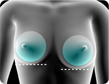 가슴 재수술 (이차 교정 유방 수술)