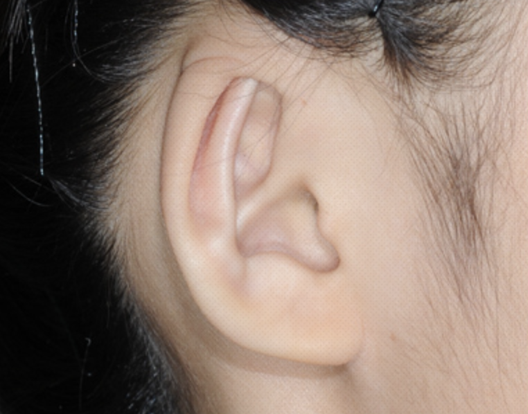 Cryptotia Correction (Buried Ear Surgery)