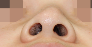 鼻中隔成形术（鼻中隔偏曲手术）