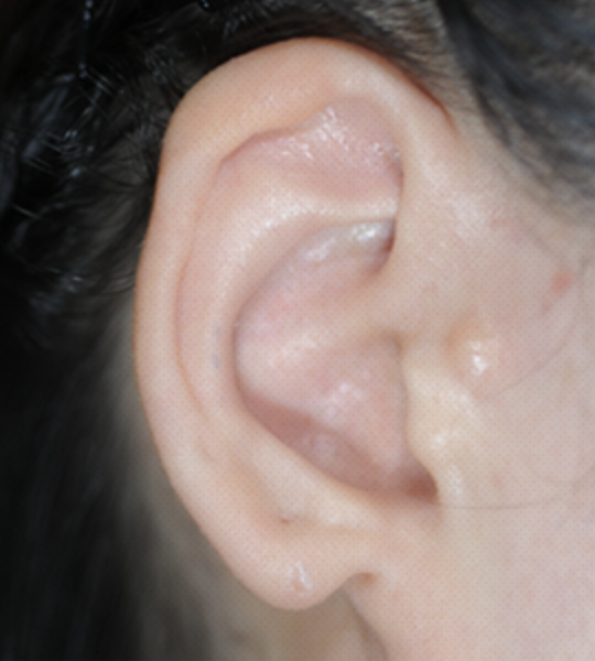 耳垂重建(先天性及后天性耳垂畸形手术)