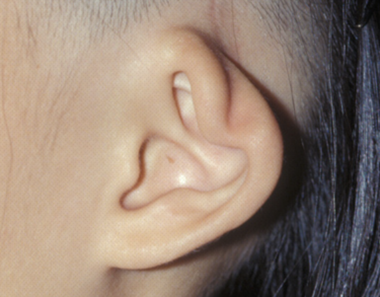 耳介拘縮形成術（カップ耳形成術）