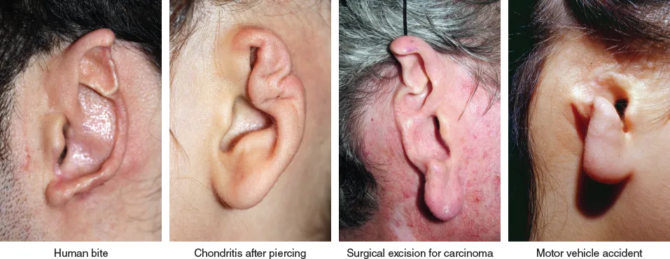 创伤性和获得性耳部缺损修复