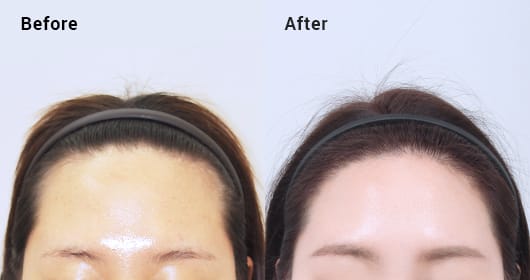 여성 헤어라인 이식