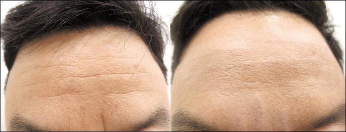 이마 리프트 (눈썹 거상술)