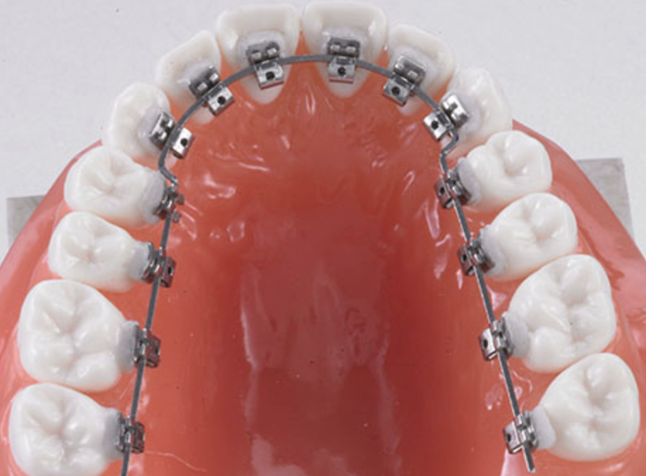 リンガルブレース