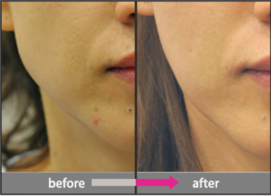 Masseter Botox (Jaw Reduction Botox)