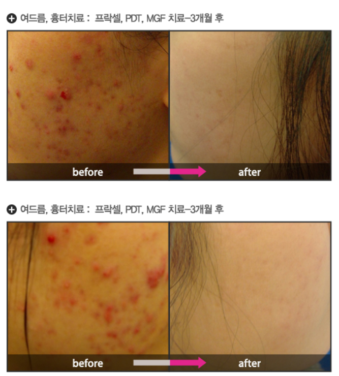 痤疮疤痕激光治疗(Action 分段式激光)