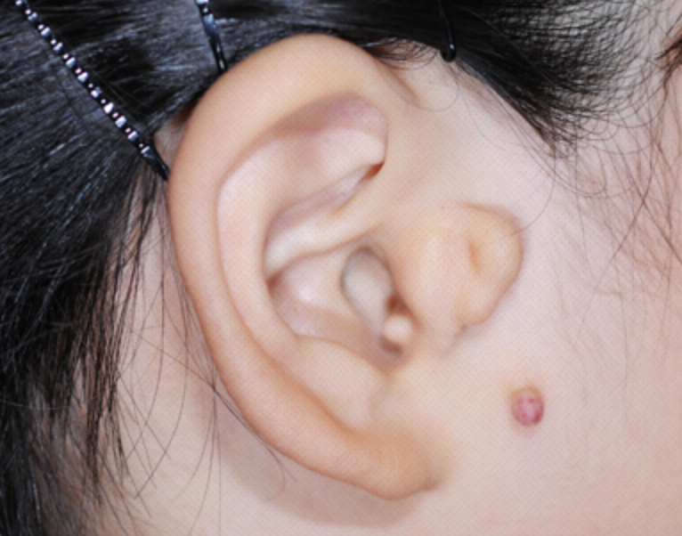 Accessory Tragus Correction (Congenital Tragal Malformation Surgery)