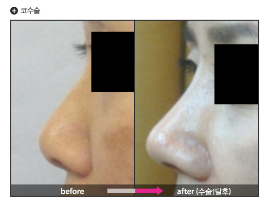 鼻整形术（鼻子手术）