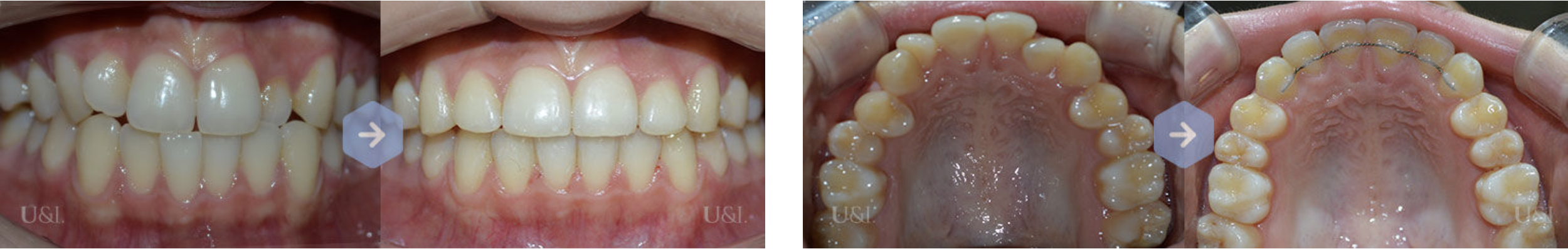비발치 교정치료