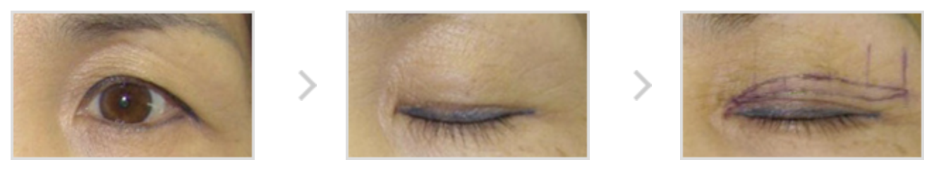 안검하수 재수술 (이차 눈꺼풀 교정)