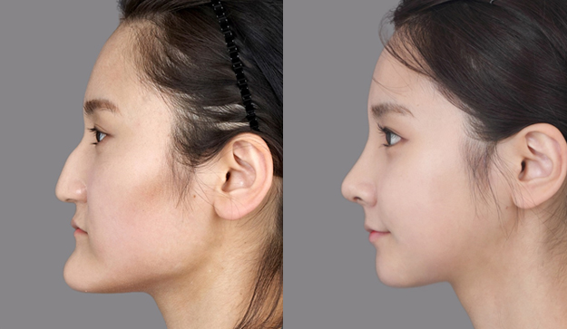 出っ歯顎矯正手術