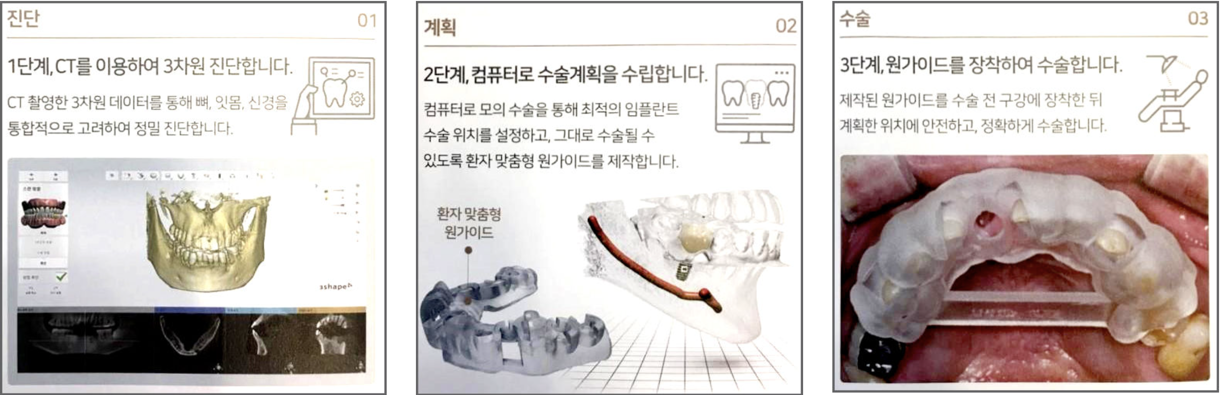 Guided Navigation Implant
