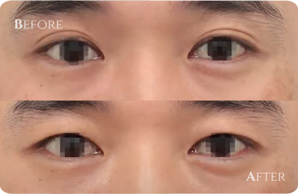 二重まぶた修正術（二重組織解除術）